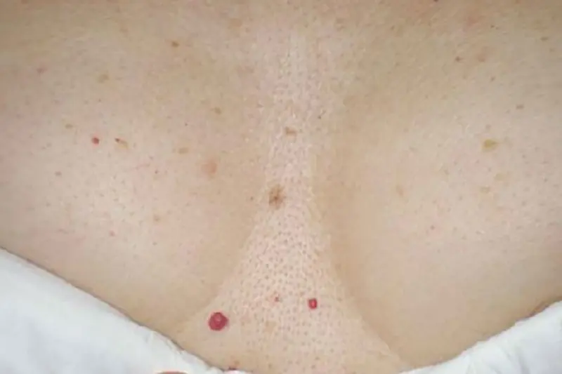 Angioma cutaneo